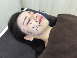 じん鍼灸整骨院　ゆいの杜院 美顔鍼（美容針）のメニュー画像