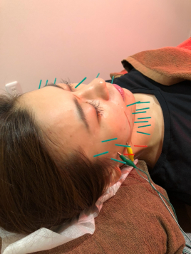 しみず接骨院・鍼灸院 美顔鍼（顔に鍼のみ）のメニュー画像
