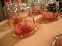 ありす鍼灸整骨院 吸い玉【カッピング】治療のメニュー画像