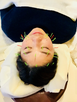 リガーレ鍼灸整骨院 美容鍼(３４本)のメニュー画像