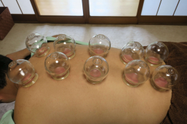 松風鍼灸院 吸玉・カッピングのメニュー画像