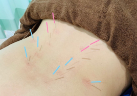 まっさ鍼灸整骨院　西八王子院 鍼灸治療のメニュー画像