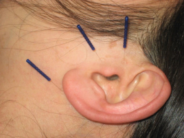 堀江鍼灸治療院 耳鳴り改善鍼灸治療セミナーのメニュー画像