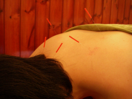 美容鍼専門サロン　西麻布鍼院 鍼灸コースのメニュー画像