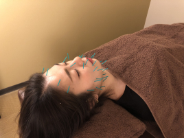 神田はりきゅう整骨院 楚々 美容鍼（スタンダード）のメニュー画像