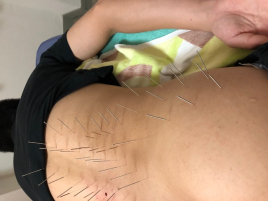 北京堂鍼灸松江 鍼治療一コマのメニュー画像