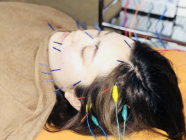 笑顔道　スイッチオン整骨院  笑顔道 美容鍼のメニュー画像