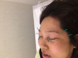 鍼灸ひより堂 眼科領域の鍼灸治療のメニュー画像