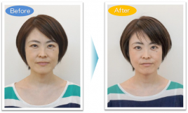 ポプラはりきゅう整骨院 美容鍼（びようはり）のメニュー画像