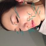赤坂青山鍼灸整骨院 美容鍼灸のメニュー画像