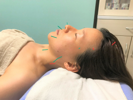 ミソラ治療室 【オプション】美容鍼灸のメニュー画像