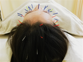 鍼灸サロンSachi 頭美鍼(頭皮鍼)のメニュー画像