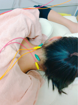 ～さくら整骨院～さくら鍼灸院 トリガーポイント鍼施術のメニュー画像