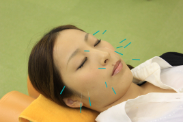アキラ鍼灸接骨院 美容鍼のメニュー画像