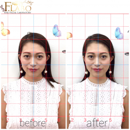 鍼灸院のたけなか 美容鍼（パルスなし）：２回目以降のメニュー画像