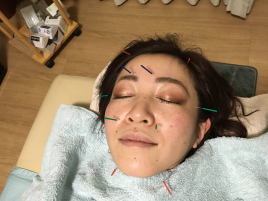 ふえふき針灸マッサージ治療院 美容針コースのメニュー画像