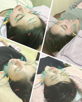 織鍼-origin- 美容鍼のメニュー画像