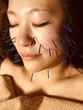 Rinato鍼灸院 美容鍼トータルケアコースのメニュー画像