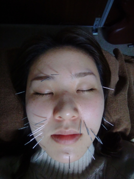 向山治療院 美顔鍼（30分） 　のメニュー画像