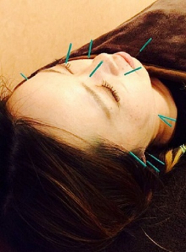 はり・きゅうサロンみかづき 美容鍼灸＋はり・きゅう(2回目以降)のメニュー画像