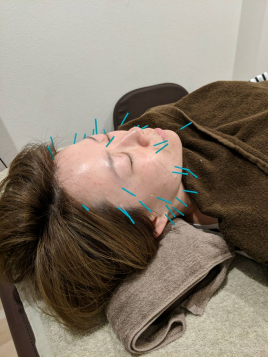 京都西大路　くすのき鍼灸整体院 美顔鍼のメニュー画像