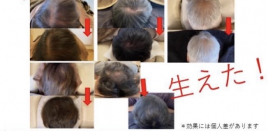 黒岩鍼灸整骨院 毛髪(抜け毛・薄毛・円形性脱毛症) のメニュー画像