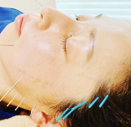 シャルム  美容鍼灸 美身鍼90分のメニュー画像