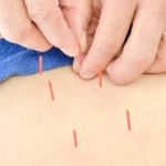 鍼灸整骨院tecu（テク） はり治療のメニュー画像