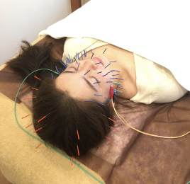Smooth吉祥寺鍼施術所 美肌小顔コース のメニュー画像