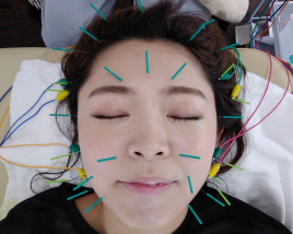 加圧 鍼灸院　ＫＡＩ-快- 美容鍼＋電気　しっかりリフトアップ★のメニュー画像