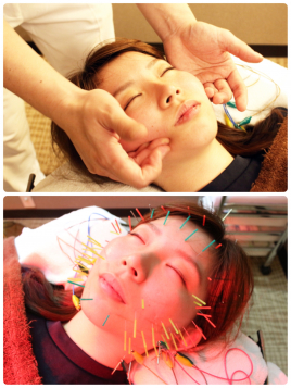 名駅せんが鍼灸院 小顔電気・美容鍼灸53本＋小顔美矯正のメニュー画像