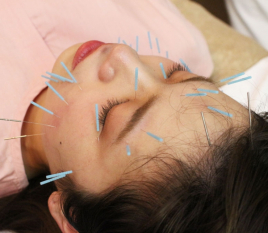 名駅せんが鍼灸院 美容鍼　38本のメニュー画像