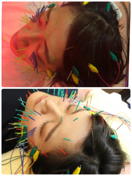 名駅せんが鍼灸院 電気美容鍼 108本のメニュー画像