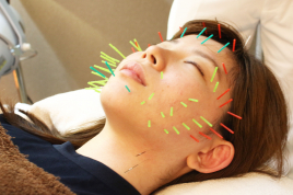 名駅せんが鍼灸院 美容鍼　53本のメニュー画像