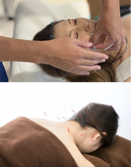 はり灸院Anchor 明石スポーツ鍼灸整体 美容鍼+全身鍼灸〜人気NO.3メニュー〜のメニュー画像