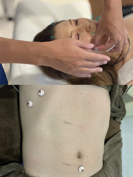 はり灸院Anchor 明石スポーツ鍼灸整体 美容鍼+内臓コンディション調整のメニュー画像