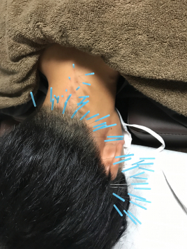おざき鍼灸整骨院　美容鍼灸サロンOZAKI 特殊鍼灸治療（３０分）のメニュー画像