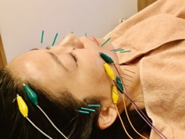 シャルム  美容鍼灸 デコルテ&ヘッド‼︎立体造顔電流美容鍼のメニュー画像