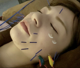 リリース鍼灸院 美容鍼灸 小顔・美肌コースのメニュー画像