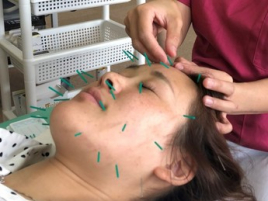 さく町はり・きゅう接骨院 美容鍼(スタンダード)のメニュー画像