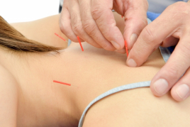 松山鍼灸ハリツボ 頭痛鍼灸治療のメニュー画像