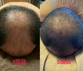 プロアスリート鍼灸整骨院 薄毛ルート治療のメニュー画像