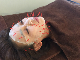 鍼灸 活法 石井治療院　 再生美容コース(幹細胞美容鍼®️)のメニュー画像