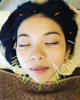 Acupuncture salon LINOA リノア鍼灸院 美容鍼灸 Standardのメニュー画像
