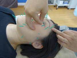 kei鍼灸院 美容鍼のメニュー画像