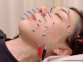 CHEER鍼灸接骨院 プレミアム美容鍼のメニュー画像