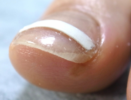 いころ鍼灸院 巻き爪治療のメニュー画像