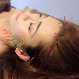 美容鍼　ledia（ルディア）堂島店 お顔と頭皮の美容鍼のメニュー画像