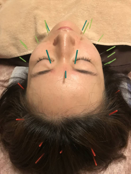 Harimo鍼灸治療院 美容鍼（全身コース）のメニュー画像