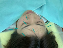 東栄鍼灸整骨院 美顔鍼　美顔ポイントコースのメニュー画像